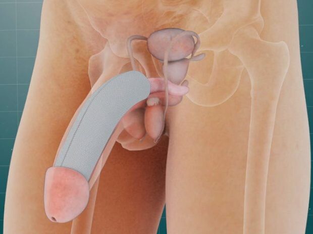Der Penis nach dem Einbringen eines speziellen Implantats unter die Haut
